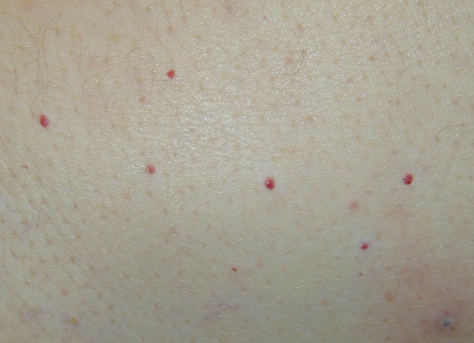 pinpoint red dots on skin about the size of a pin head