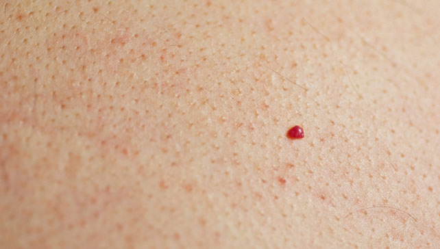 pinpoint red dots on skin cancer